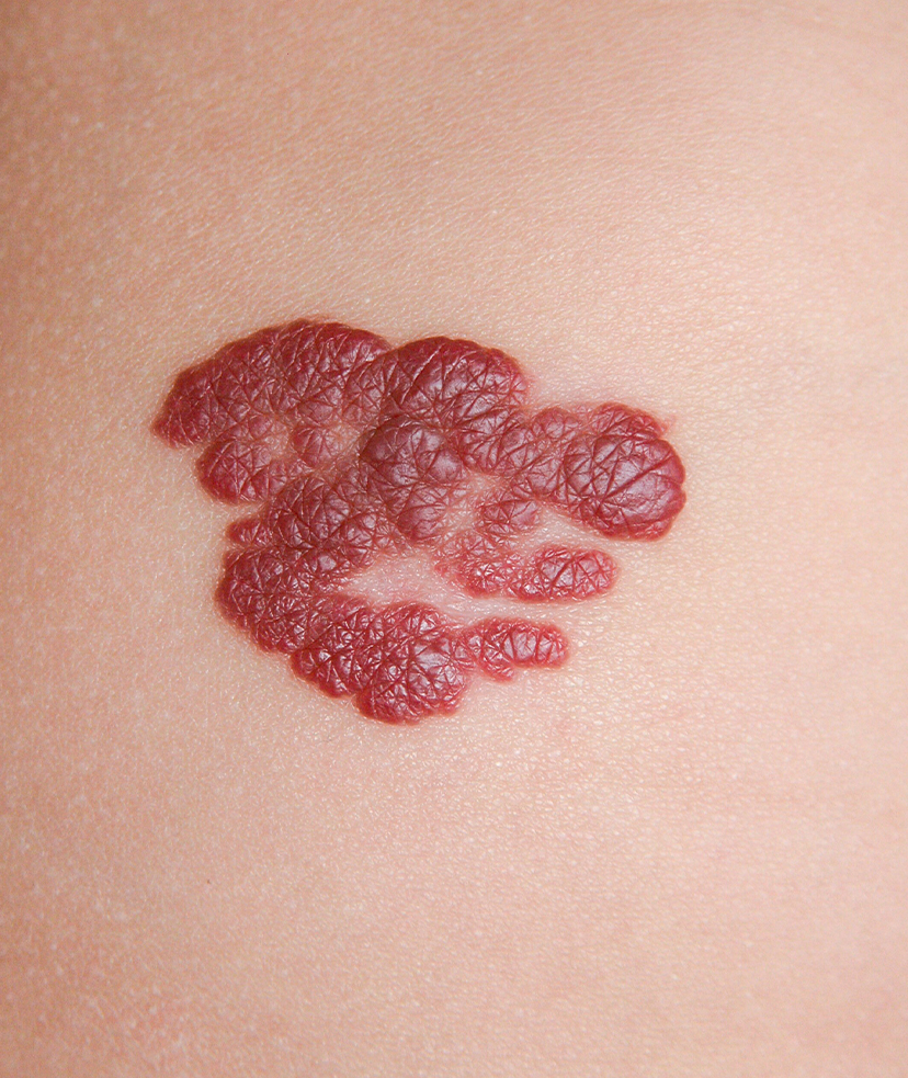 Photo of a hemangioma on a person's skin