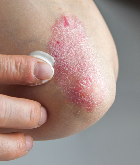 Photo of a psoriasis rash on person's elbow