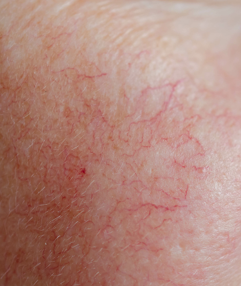 Photo of vascular lesions on a person's skin