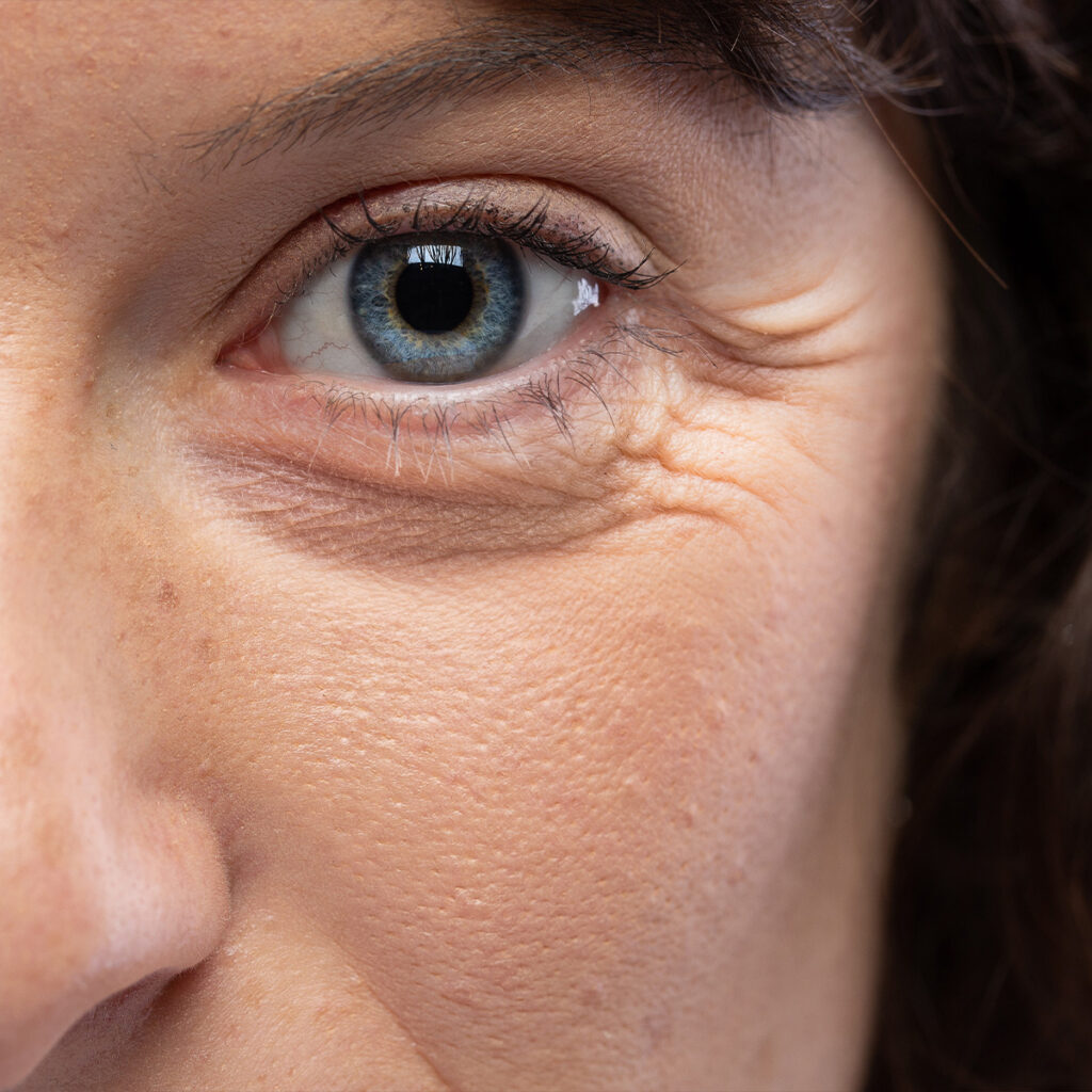 Photo of crow's feet wrinkles around a woman's blue eye
