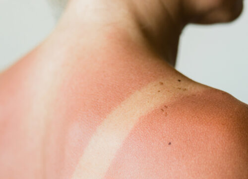 Photo of sun damage on a woman's shoulders