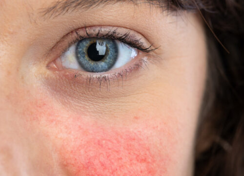 Photo of a woman's face with rosacea
