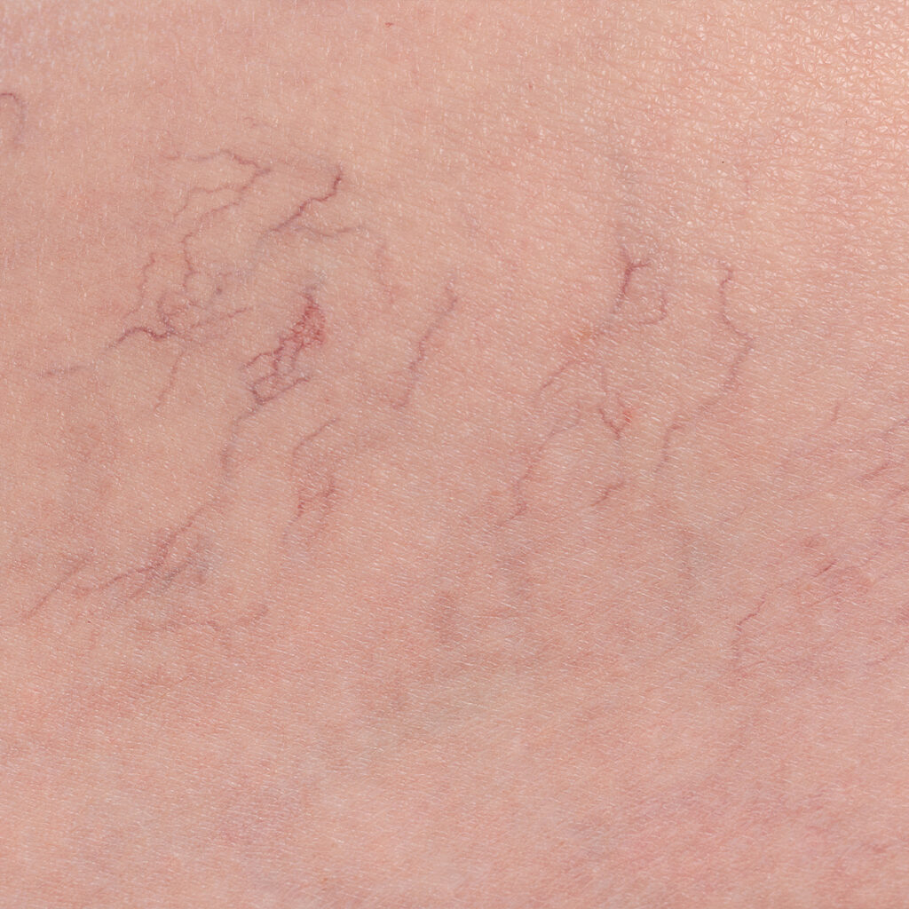 Photo of spider veins on a person's skin
