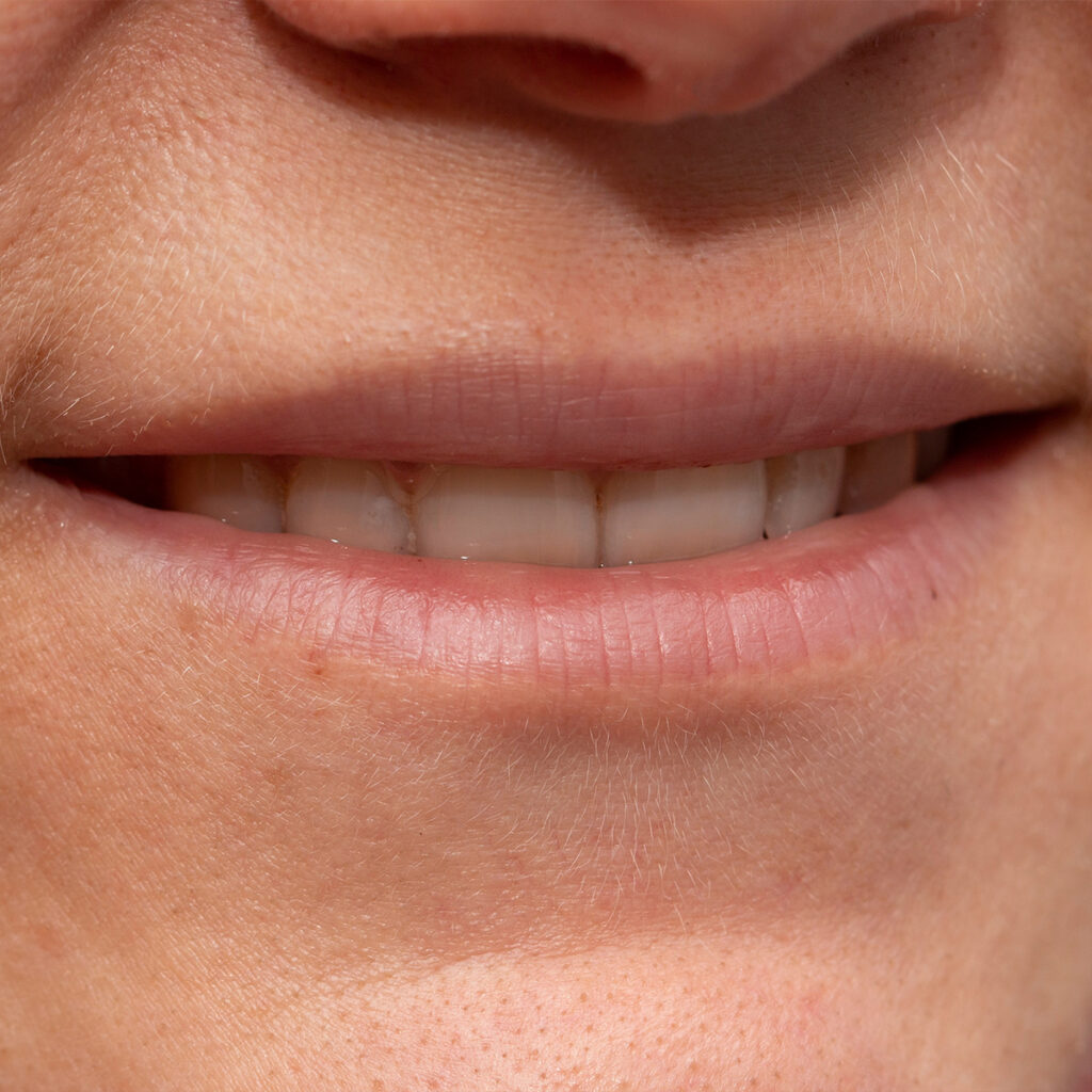 Photo of a woman's thin lips and teeth