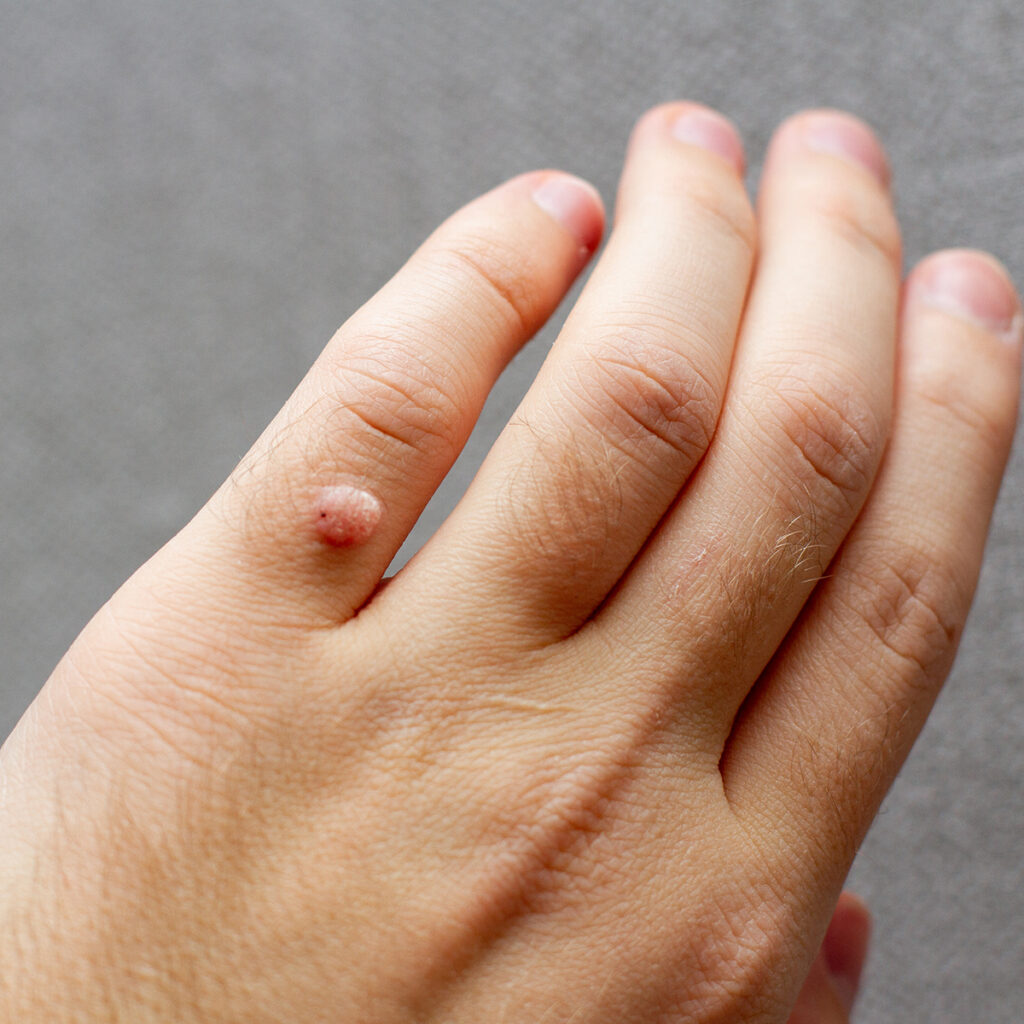 Photo of a wart on a person's hand