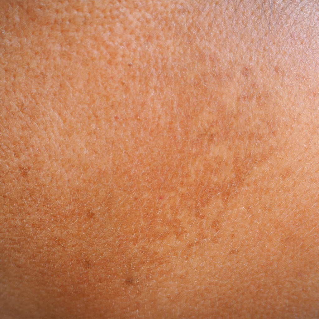Photo of sun-damaged skin