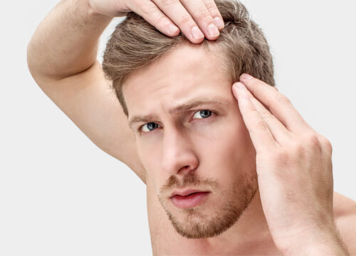 Photo of a man checking his hairline for hair loss