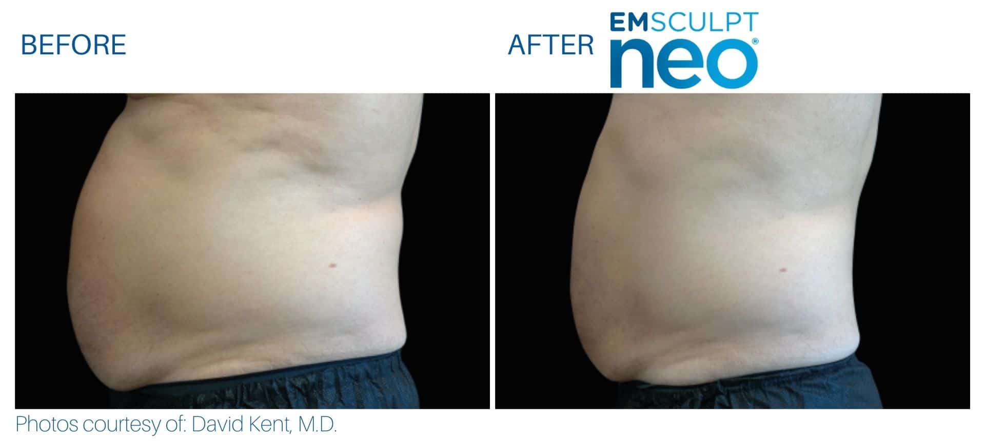 Side-by-side photos show a person's abdomen before and after an Emsculpt NEO session, highlighting the visible reduction in abdominal size achieved with Emsculpt NEO treatment.