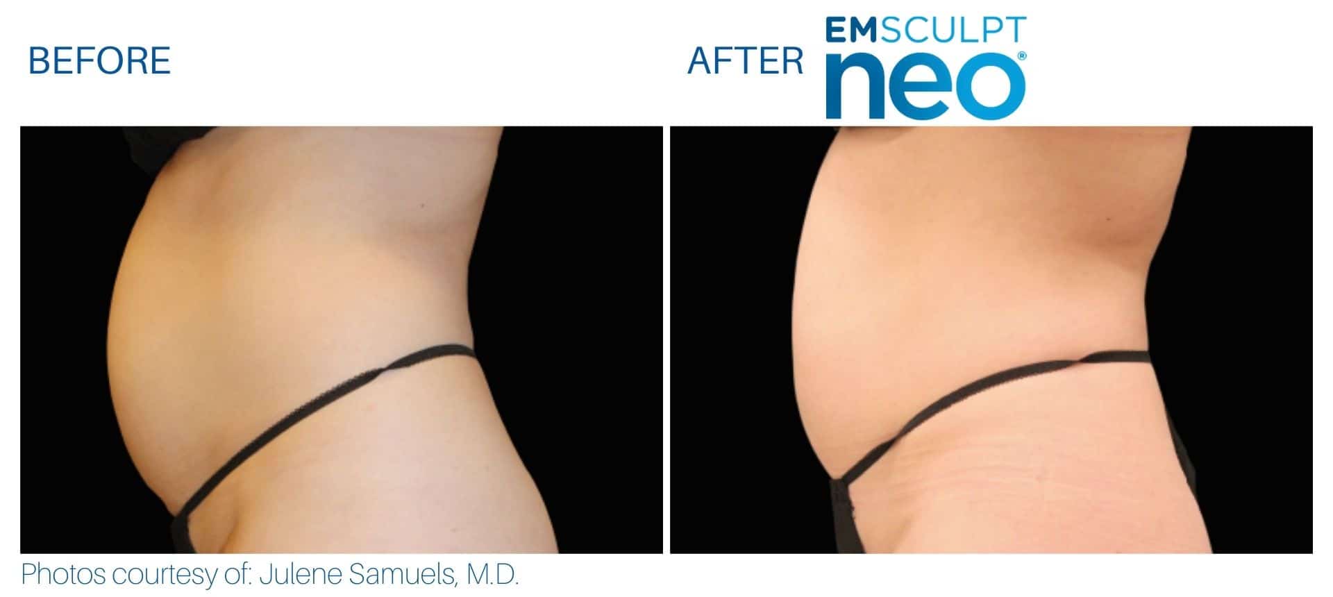Side-by-side comparison of a person's abdomen before and after Emsculpt NEO treatment, highlighting a noticeable reduction in abdominal size.