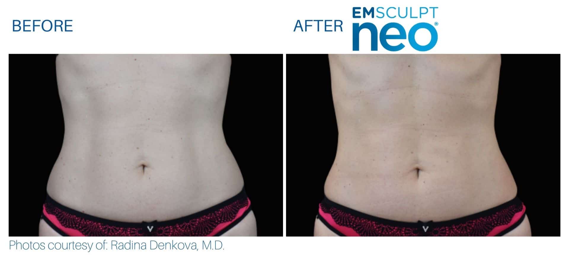 Side-by-side comparison of a person's abdomen before and after Emsculpt NEO treatment, highlighting reduced abdominal fat.