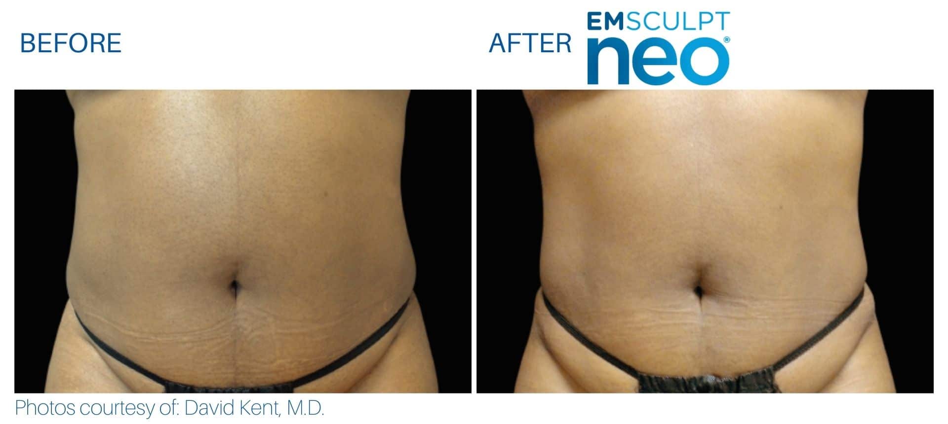 Before-and-after photos of a person's midsection reveal visible reduction in abdominal fat following Emsculpt NEO, highlighting the treatment’s transformative effects.