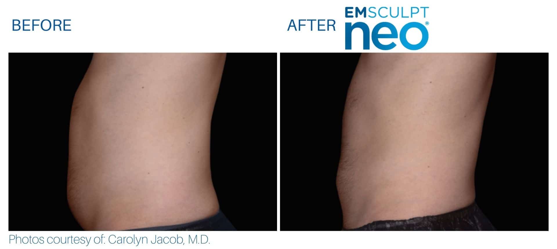Side-by-side comparison of a person's abdomen before and after Emsculpt NEO treatment, highlighting the reduction in visible abdominal fat achieved with Emsculpt NEO.