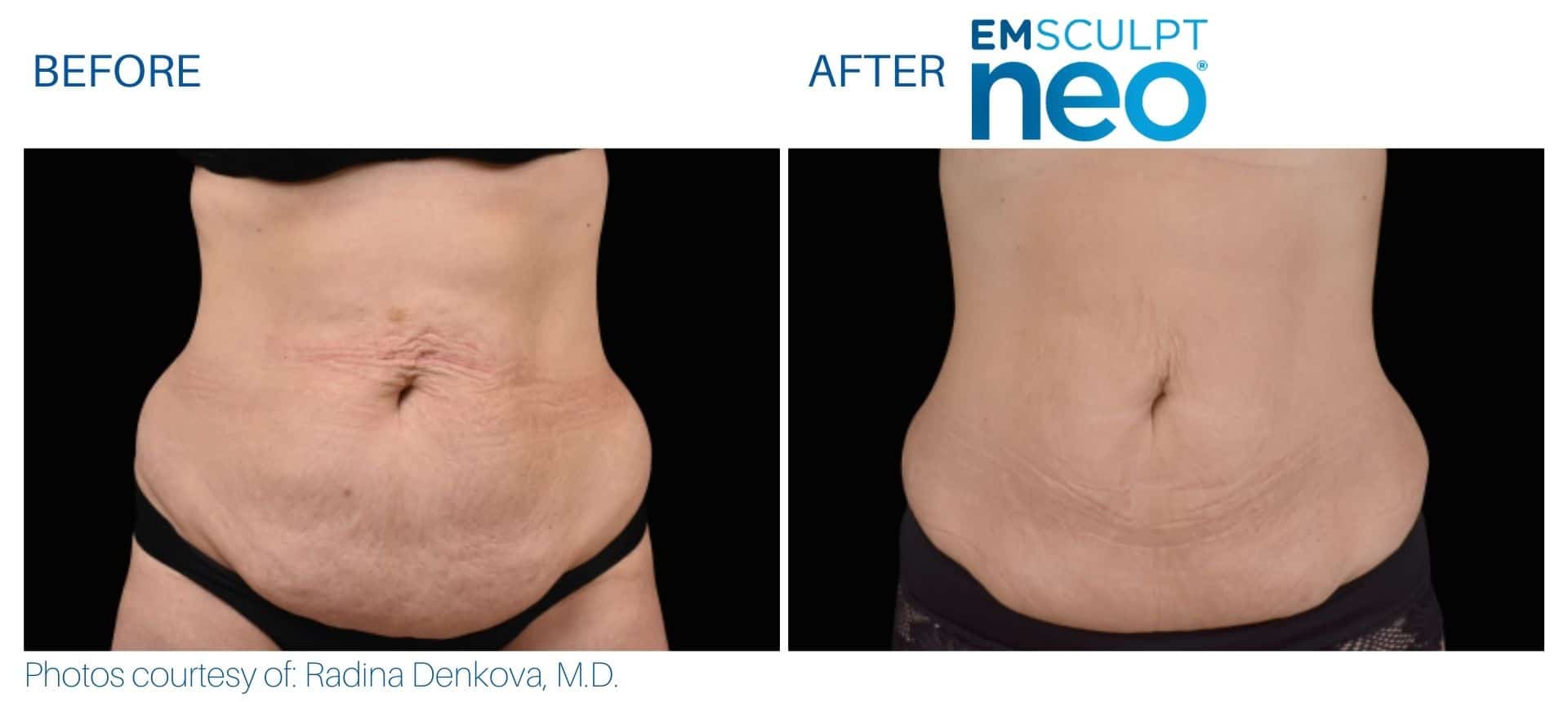 Before and after photos show a person's abdomen with loose skin and fat reduction following Emsculpt NEO treatment.