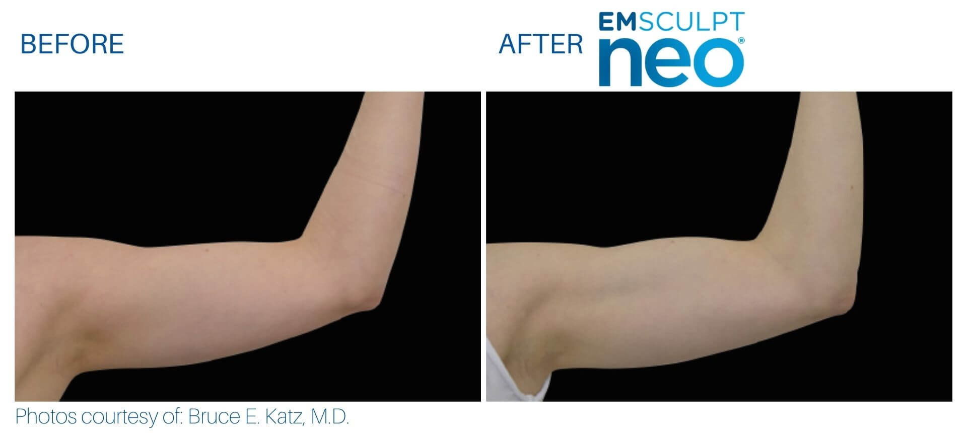 Side-by-side comparison of an arm before and after Emsculpt NEO treatment, highlighting enhanced muscle definition and noticeable fat reduction in the after image.