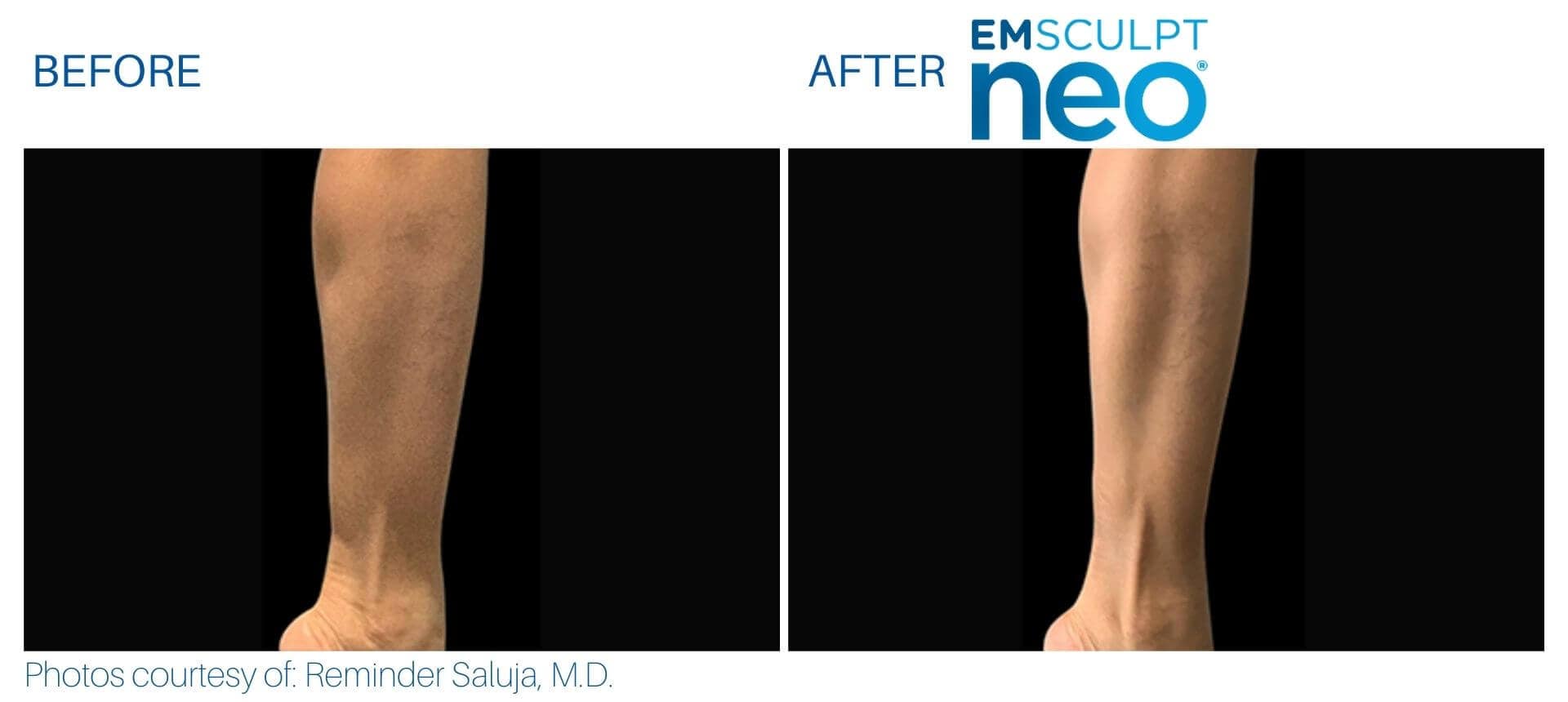 Side-by-side comparison of a lower leg before and after Emsculpt NEO treatment, highlighting smoother, more toned skin in the post-Emsculpt NEO image.