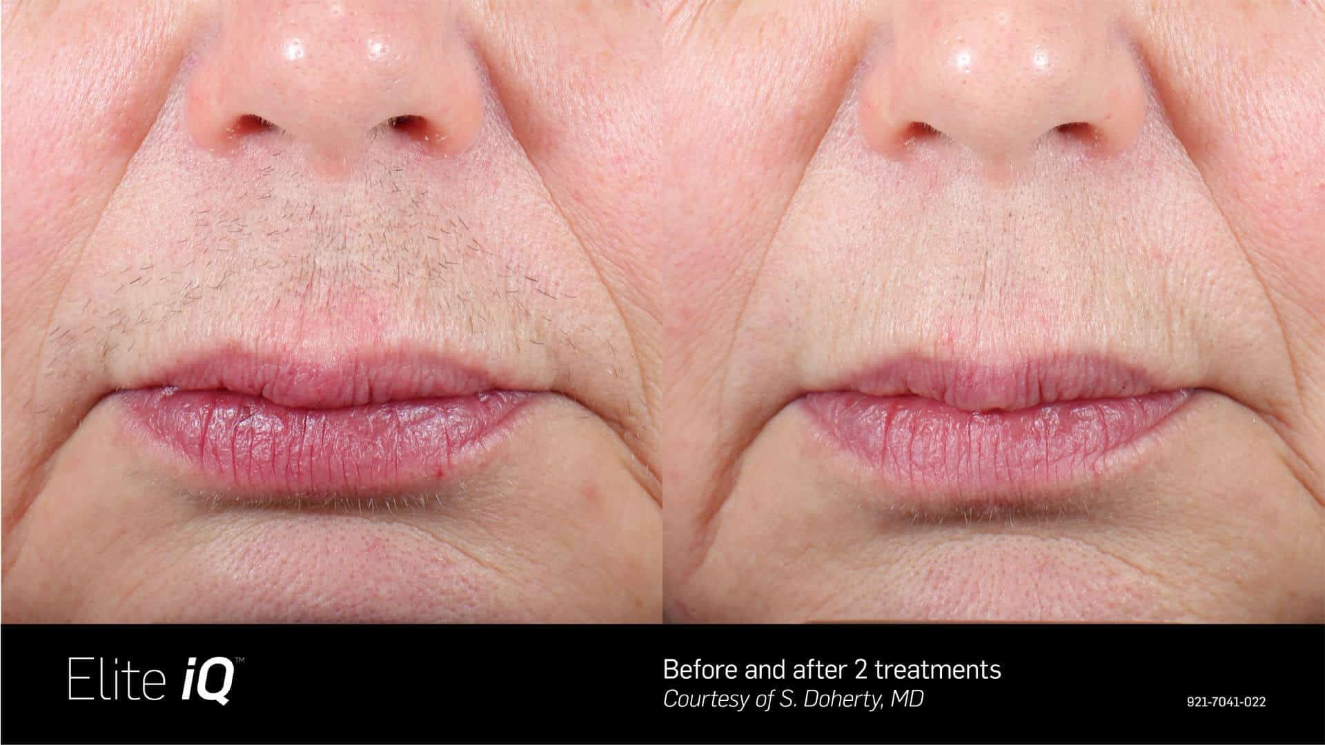 Close-up of an upper lip area before and after two Elite iQ laser hair removal treatments, showing significant hair reduction and smoother skin in the after image.