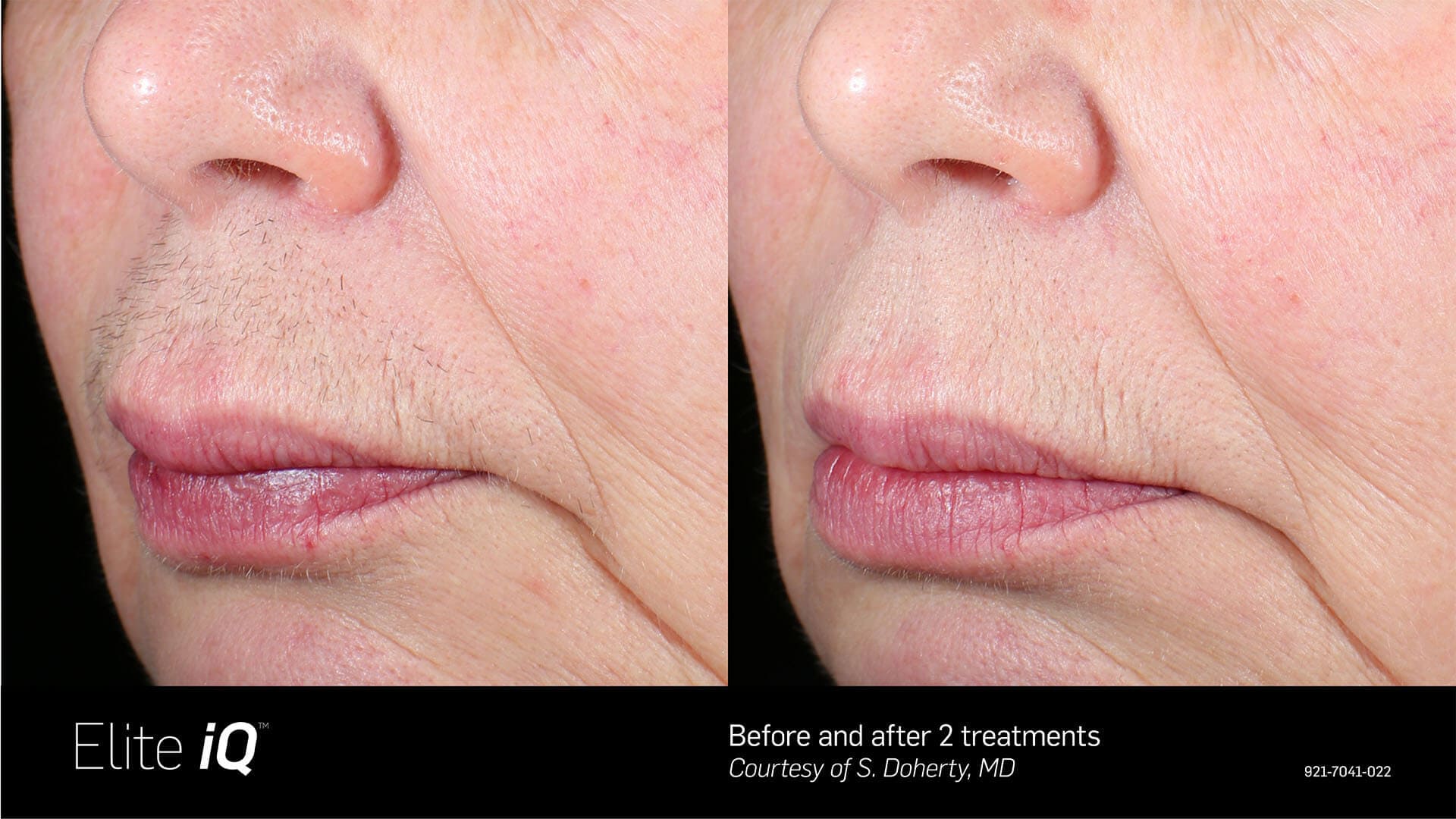 Side-by-side close-up of an upper lip and chin before and after two Elite iQ Laser Hair Removal treatments, showing noticeable hair reduction and smoother skin on the right.