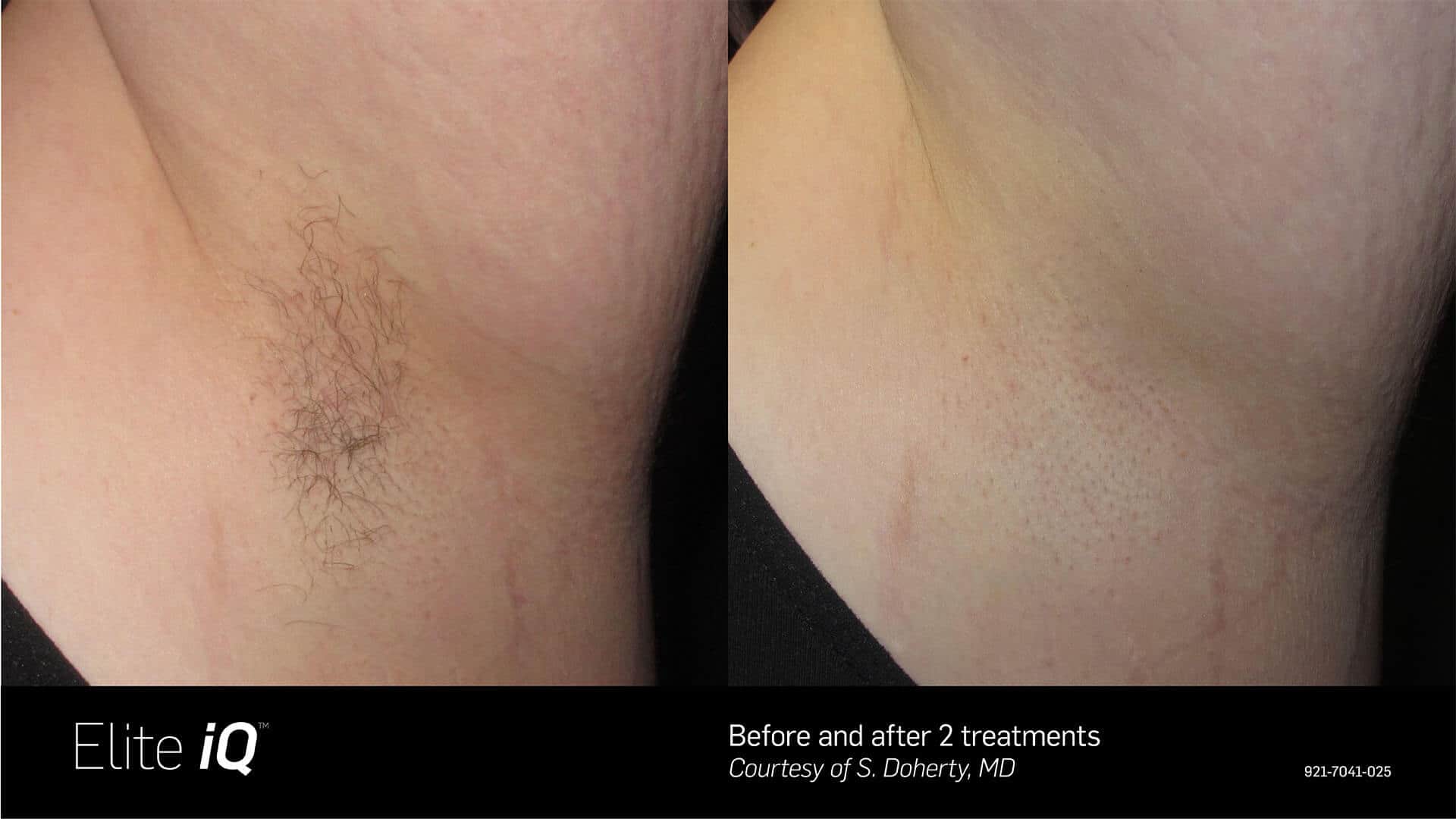 Side-by-side images show an underarm before (left, with hair) and after (right, mostly smooth) two Elite iQ laser hair removal treatments, highlighting noticeable hair reduction.