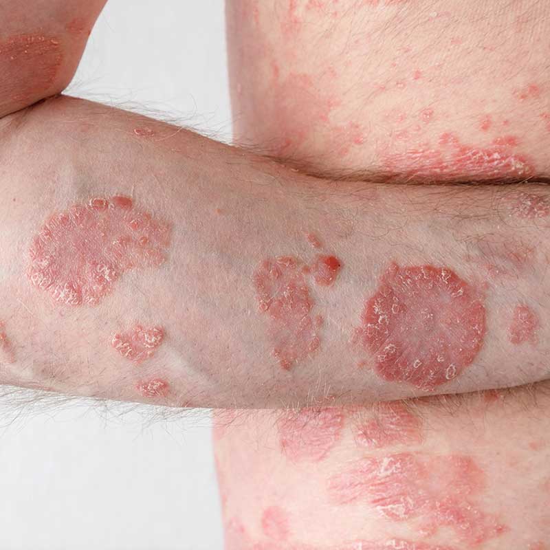 Close-up of a person's arm and leg showing red, scaly, and inflamed patches of skin, characteristic of a chronic skin condition such as psoriasis.