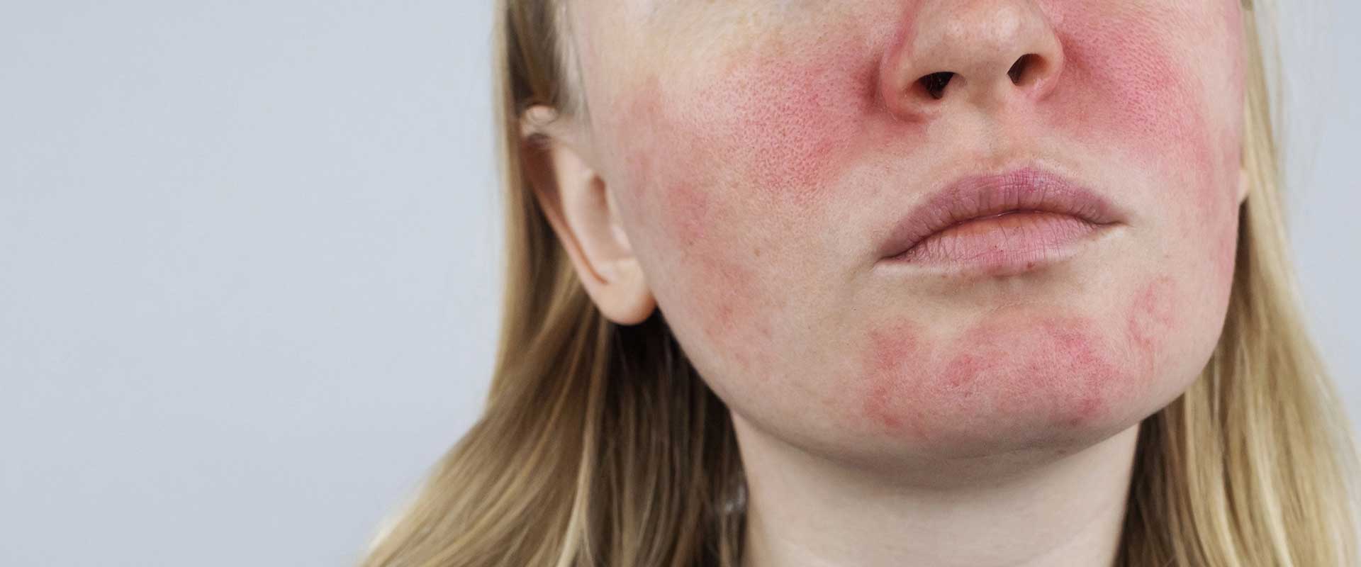 Close-up of a person with pale skin and blonde hair showing red, irritated patches on the cheeks, nose, and chin.