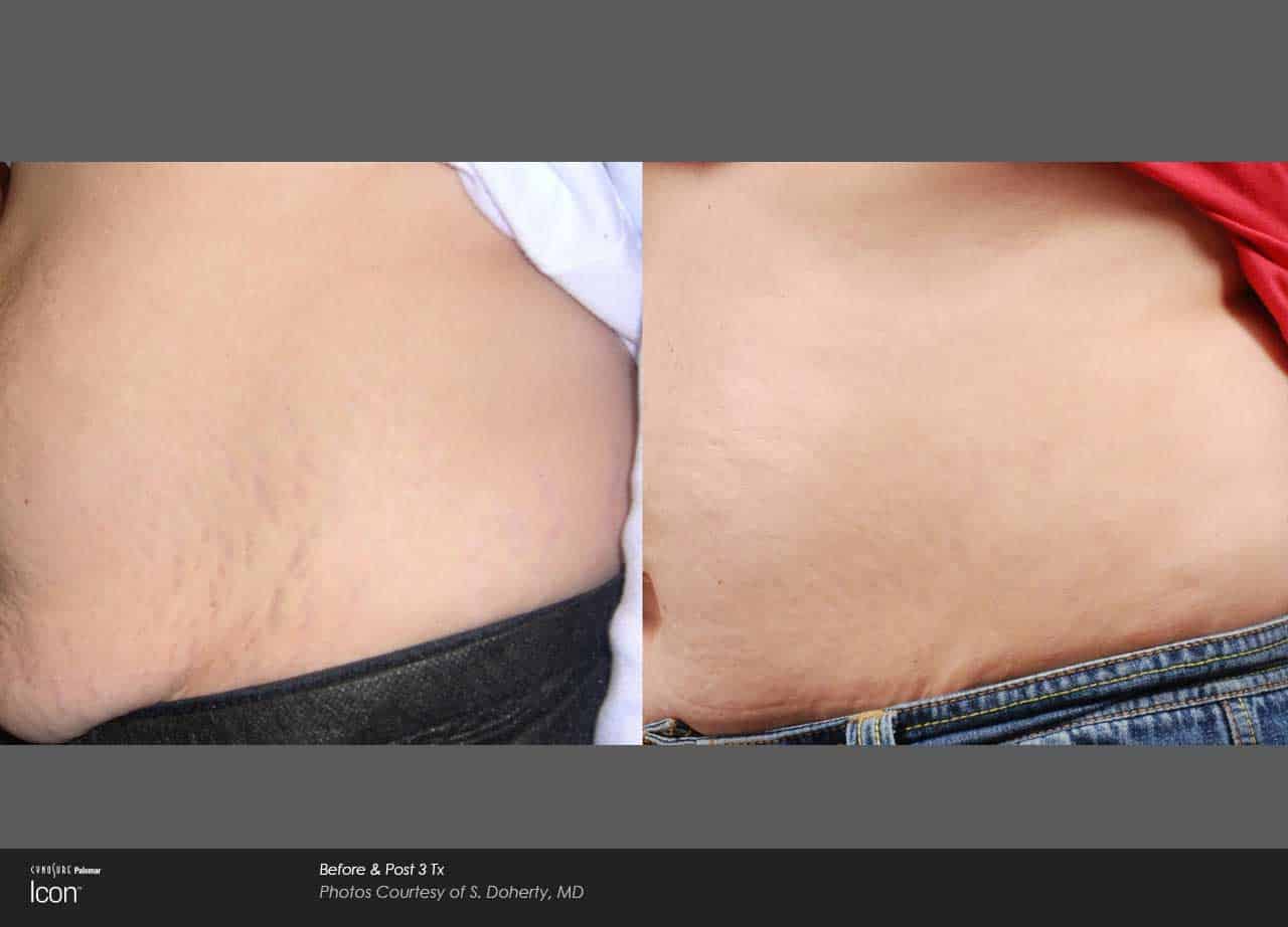 Side-by-side comparison of lower back skin: visible stretch marks on the left and smoother skin with visibly reduced stretch marks on the right.