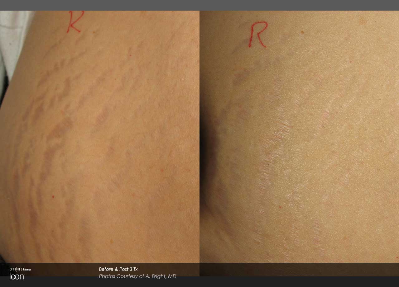 Close-up comparison of skin with Stretch Marks before (left) and after (right) treatment, highlighting the reduced visibility of Stretch Marks post-treatment.