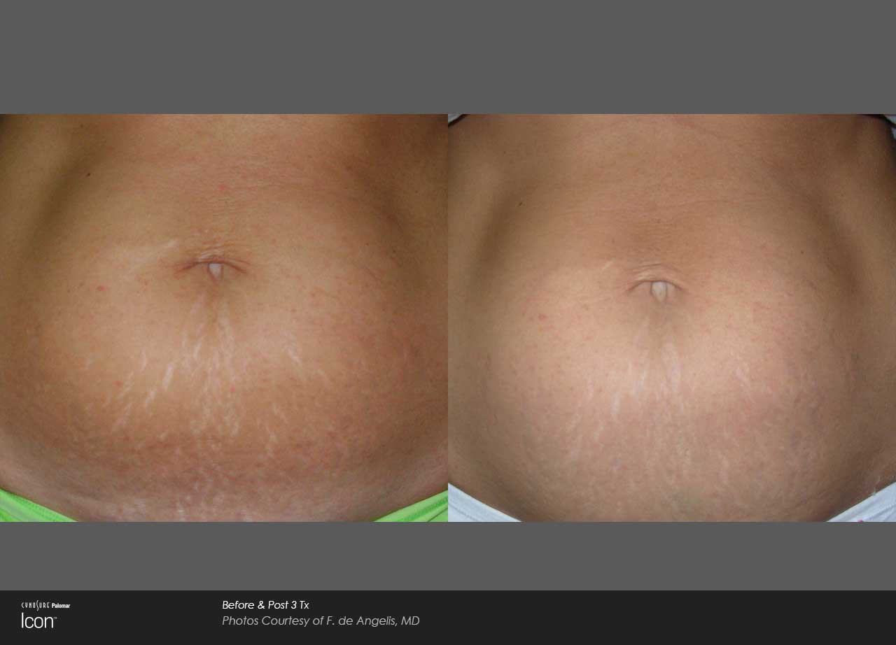 Side-by-side comparison of a person's abdomen shows stretch marks before (left) and after (right) skin care treatment, highlighting the visible reduction in stretch mark appearance.