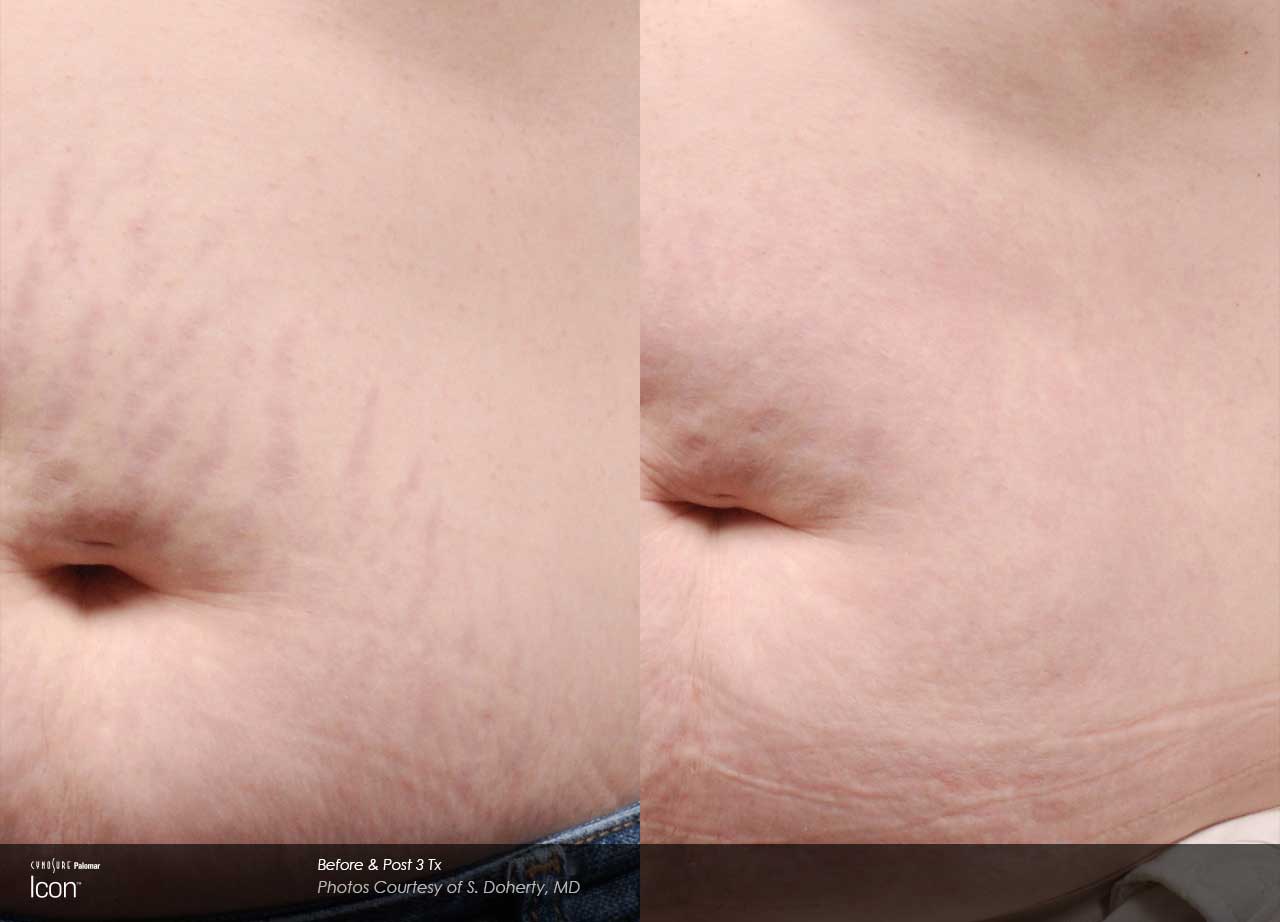 Side-by-side close-up of an abdomen displays stretch marks on the left and smoother skin with visibly reduced stretch marks on the right, labeled as a before and after comparison.