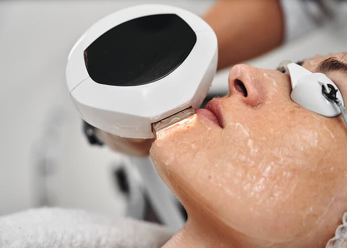 A person undergoes a facial cosmetic procedure using an Icon Laser handheld device for skin resurfacing while wearing protective goggles.
