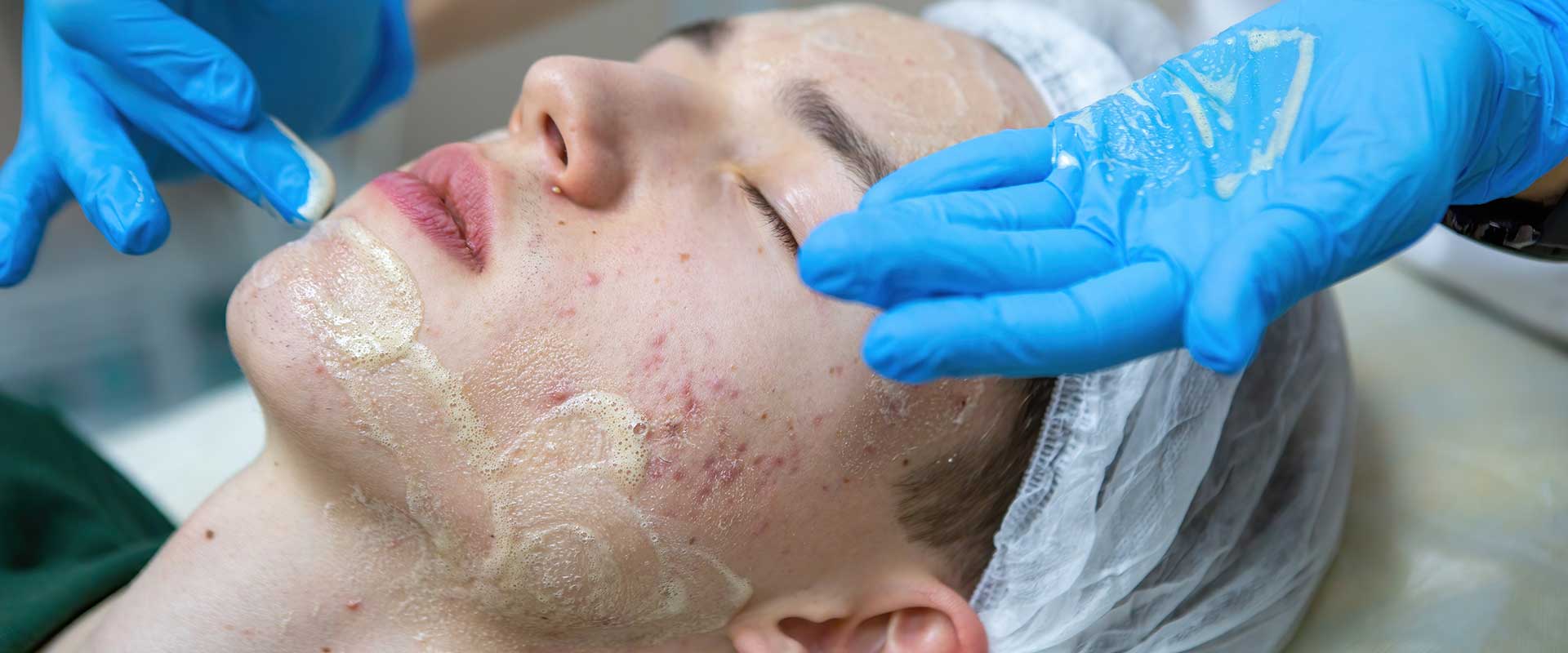 A person with visible acne scarring receives a chemical peel treatment from a gloved professional while lying down with eyes closed.