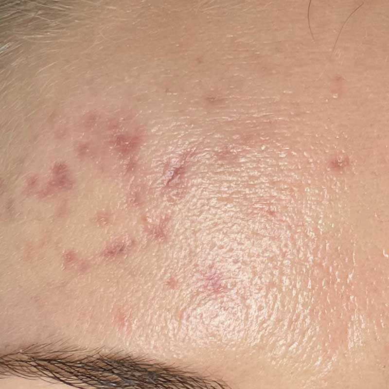 acne scar image 3