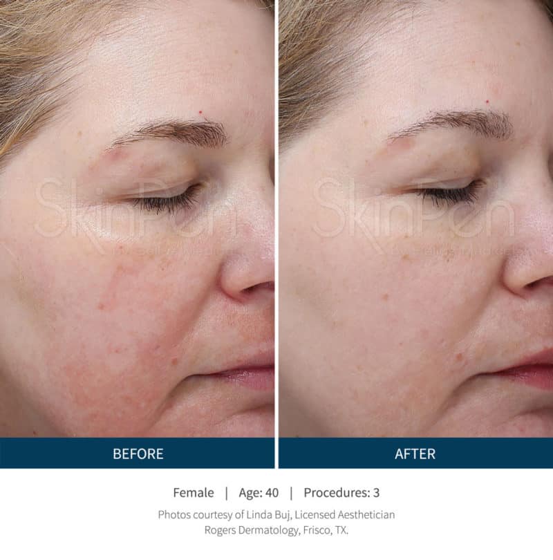 Side-by-side close-up of a woman's face showing reduced redness and smoother skin texture after three SkinPen microneedling procedures.