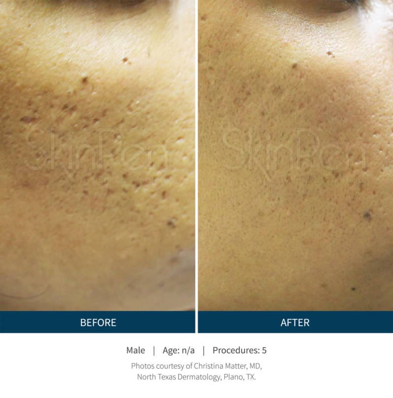 Side-by-side comparison of facial skin before and after Microneedling treatment, showing reduction in acne scars and smoother skin texture after five procedures.