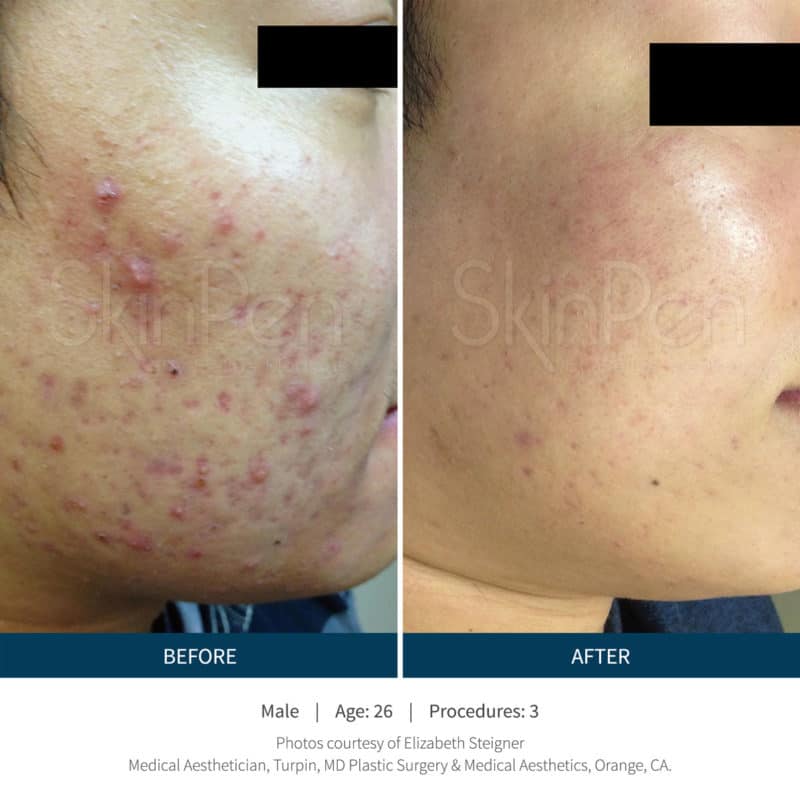 Side-by-side comparison of a man's cheek before and after three SkinPen microneedling procedures, showing reduced acne and noticeably smoother skin in the after image.