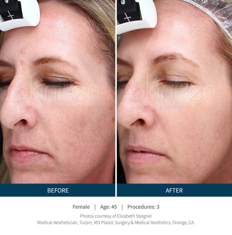 Side-by-side close-up photos of a woman’s face, showing skin texture and tone before (left) and after (right) three SkinPen Microneedling procedures.