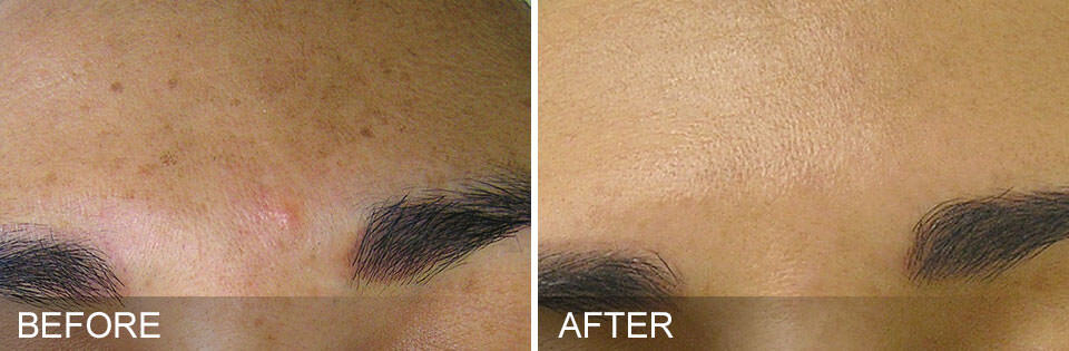 Close-up comparison of a forehead before and after HydraFacial treatment; the left side shows dark spots and blemishes, while the right side appears clear and even-toned.