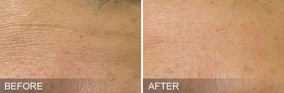 Side-by-side close-ups of a forehead, showing more visible wrinkles in the "before" image and smoother skin after a HydraFacial skincare treatment.