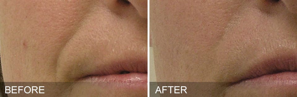 Close-up comparison of skin near the mouth after a HydraFacial, showing visibly reduced wrinkles and a smoother texture in the “after” image versus the “before” image.