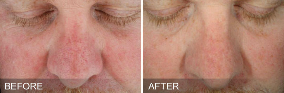 Side-by-side photos show a man's nose and cheeks before and after facial treatment, with visible redness reduced in the "after" image.