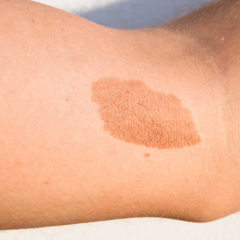 birthmark v2