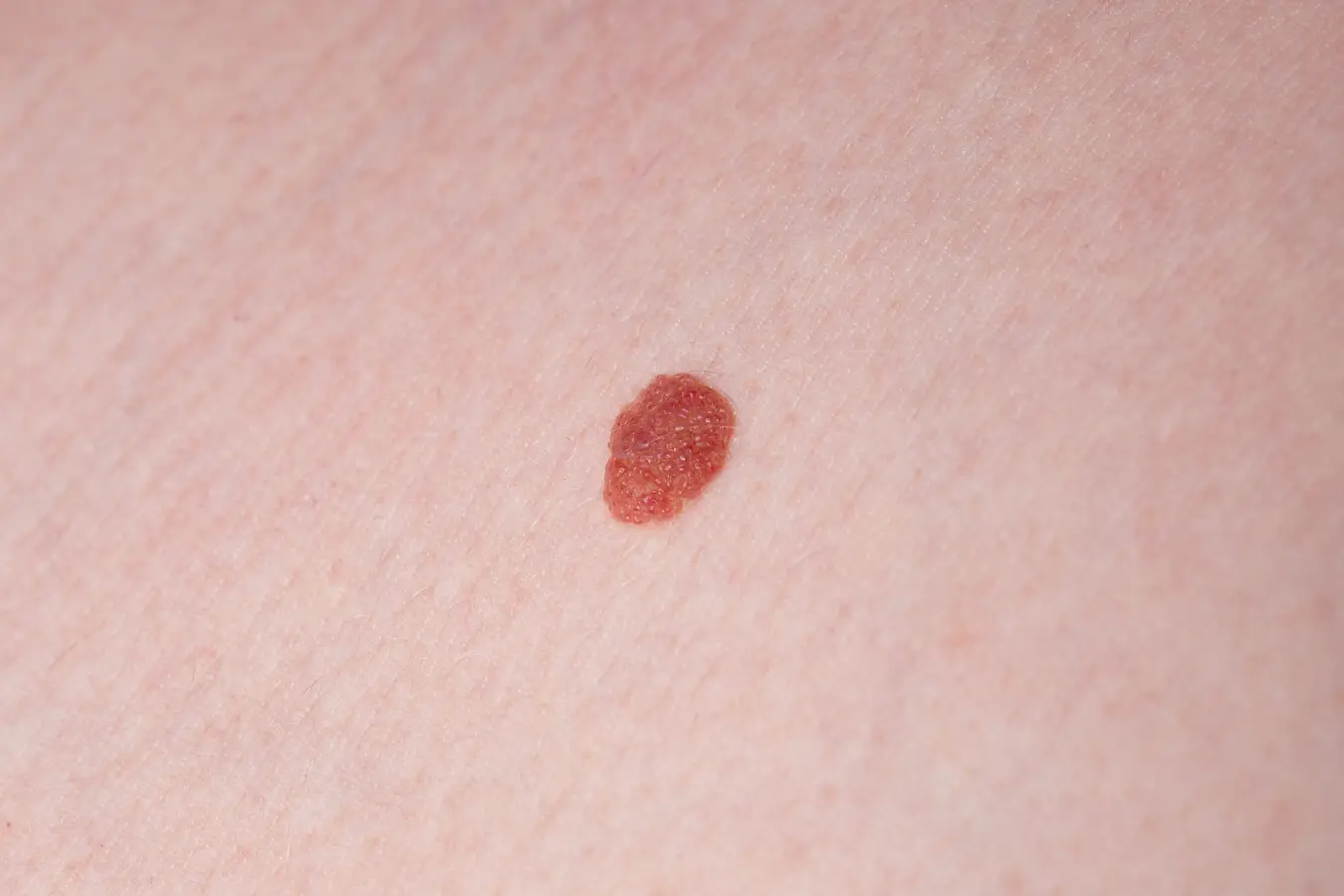birthmarks