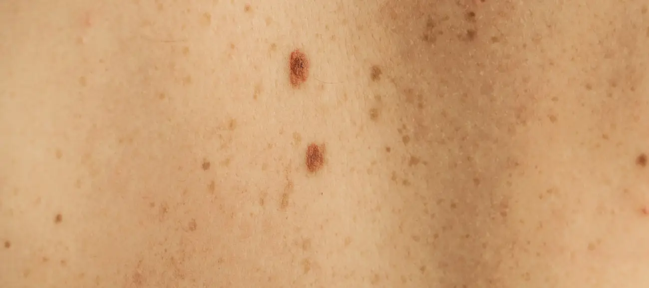 brithmarks2