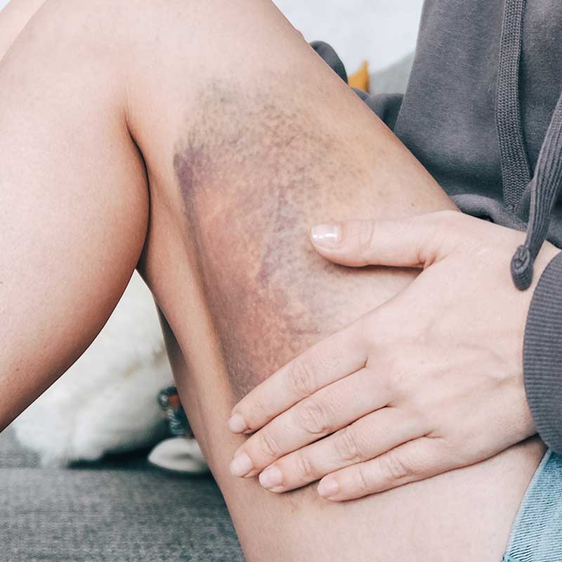 A person sits with their hand resting on their thigh, which has a large, dark purple and yellow bruise, alongside visible broken blood vessels.