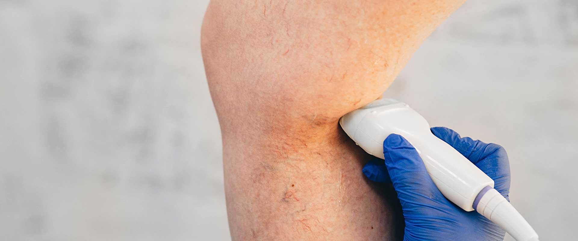 A person’s knee is being examined with an ultrasound device by someone wearing blue medical gloves, possibly checking for spider veins or broken blood vessels.