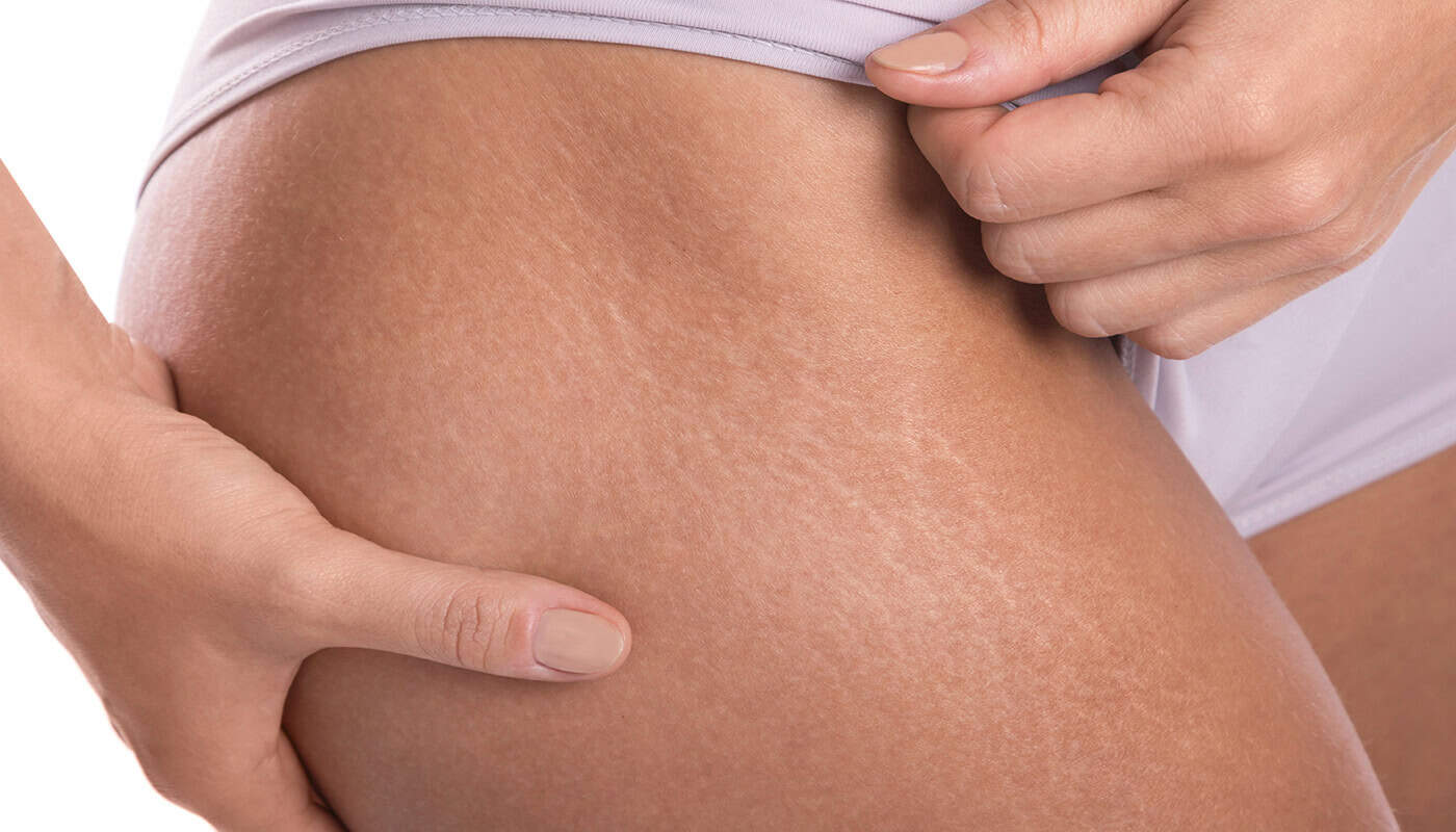 Close-up of a person’s upper thigh, revealing visible stretch marks. One hand holds the skin while another rests on top, all while wearing light-colored underwear.