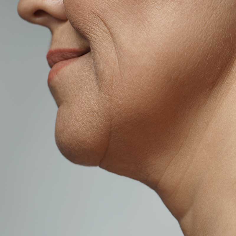 Close-up side view of a middle-aged person's lower face, showing a double chin and smooth skin with visible fine lines.