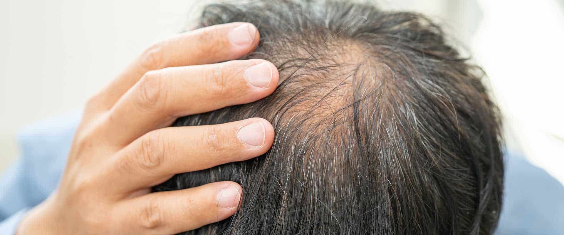 A person touching the top of their head, highlighting thinning hair and a visible scalp—common signs of hair loss.