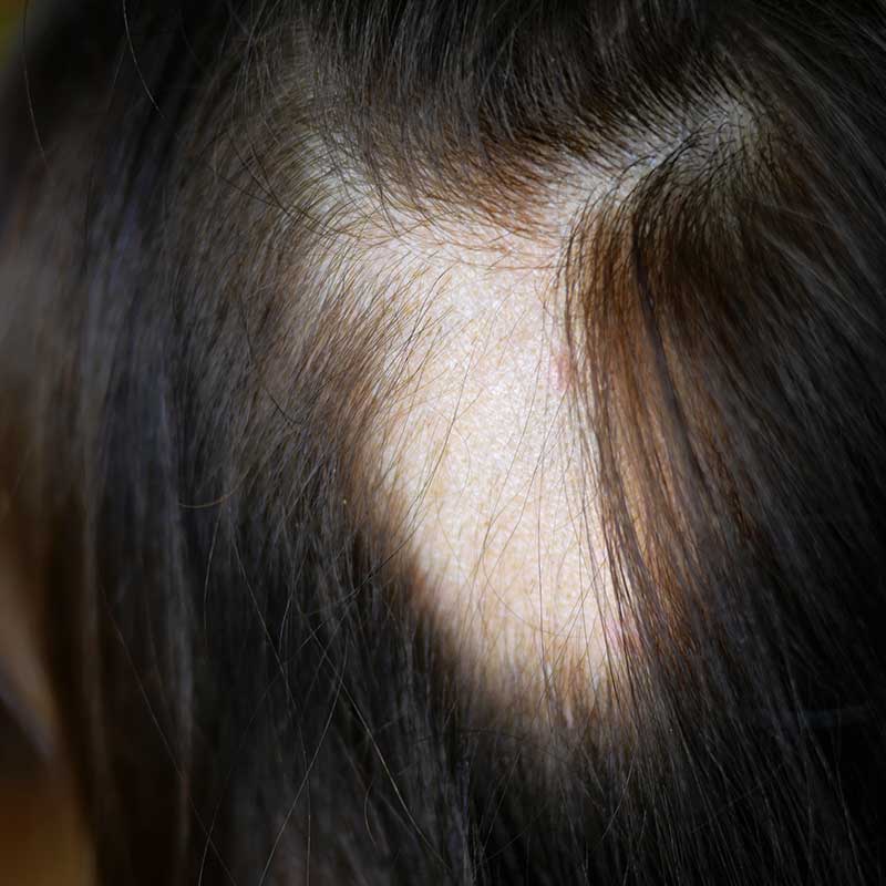 A close-up view of a person's scalp showing a noticeable patch of hair loss and thinning, surrounded by dark hair.