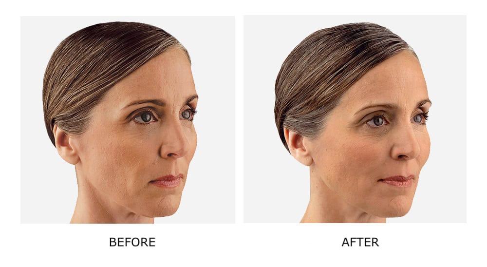 Side-by-side images of a woman's face showing "before" and "after" JUVÉDERM Fillers, highlighting noticeable changes in her facial appearance.