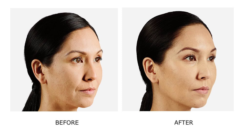 Side-by-side photos show a woman before and after JUVÉDERM fillers; her skin appears smoother and more even-toned in the "after" image.